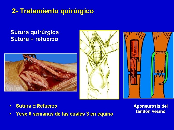 2 - Tratamiento quirúrgico Sutura quirúrgica Sutura + refuerzo • Sutura Refuerzo • Yeso