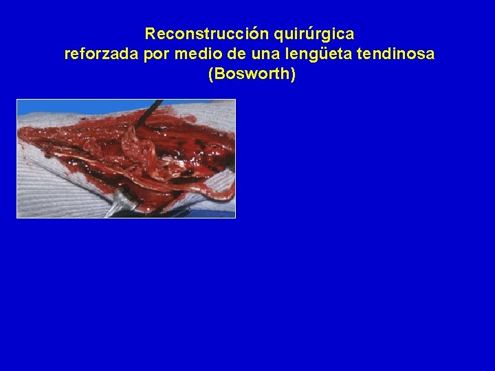 Reconstrucción quirúrgica reforzada por medio de una lengüeta tendinosa (Bosworth) 