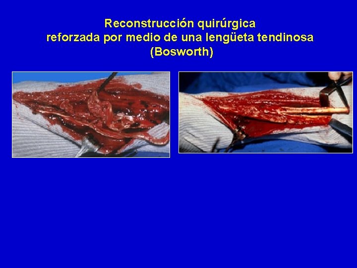 Reconstrucción quirúrgica reforzada por medio de una lengüeta tendinosa (Bosworth) 