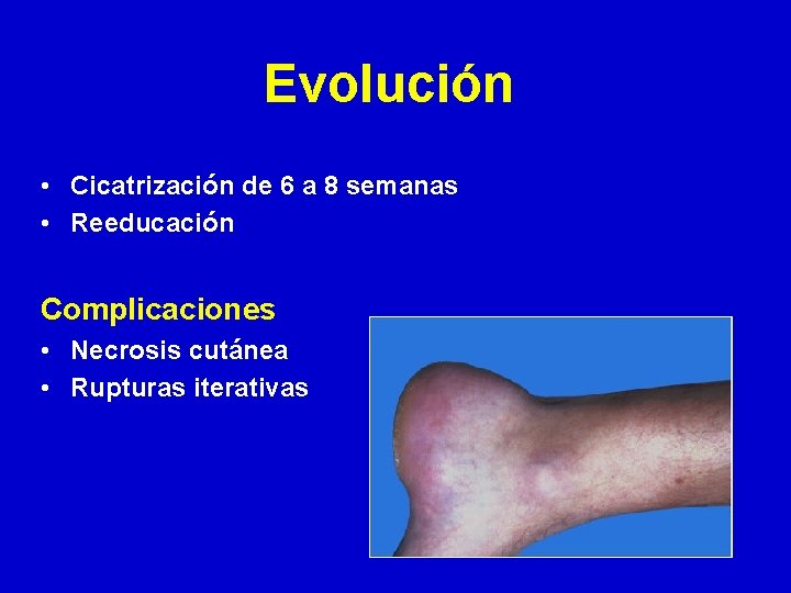 Evolución • Cicatrización de 6 a 8 semanas • Reeducación Complicaciones • Necrosis cutánea