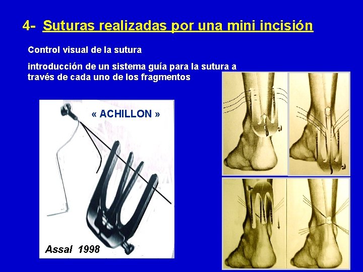  4 - Suturas realizadas por una mini incisión Control visual de la sutura