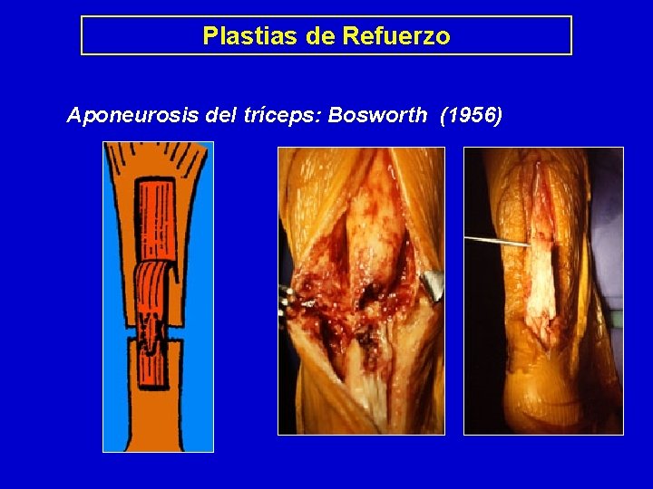 Plastias de Refuerzo Aponeurosis del tríceps: Bosworth (1956) 