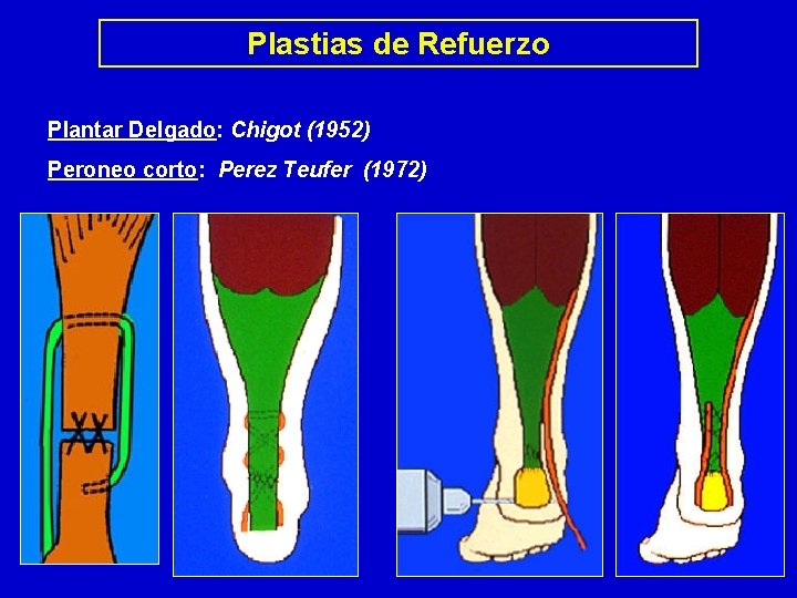 Plastias de Refuerzo Plantar Delgado: Chigot (1952) Peroneo corto: Perez Teufer (1972) CHIGOT PEREZ