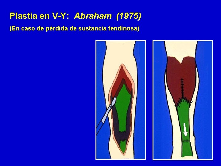 Plastia en V-Y: Abraham (1975) (En caso de pérdida de sustancia tendinosa) 