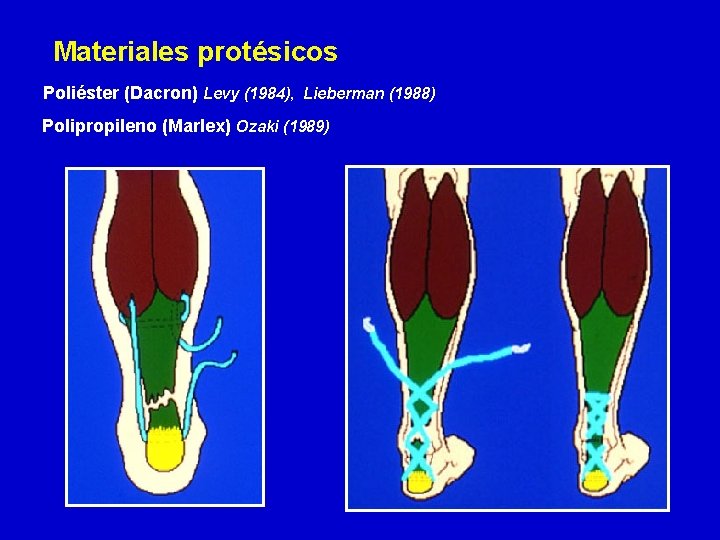  Materiales protésicos Poliéster (Dacron) Levy (1984), Lieberman (1988) Polipropileno (Marlex) Ozaki (1989) 