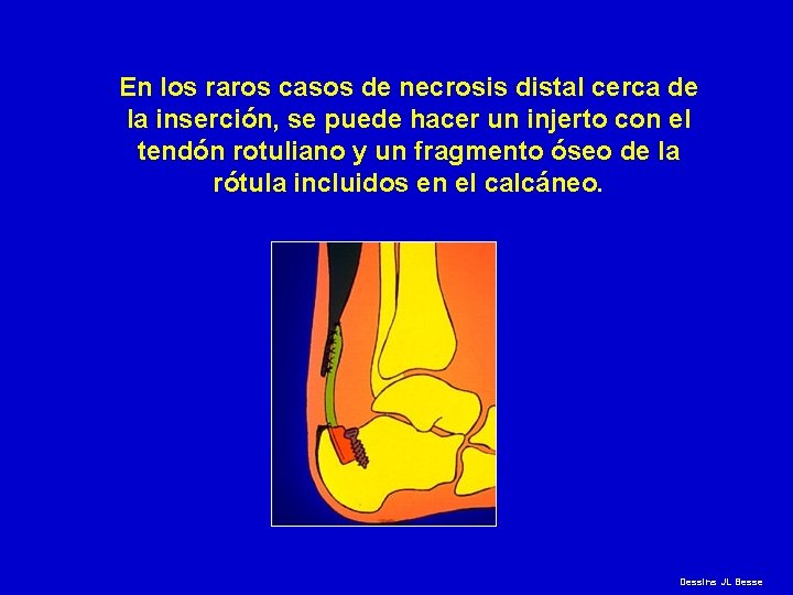 En los raros casos de necrosis distal cerca de la inserción, se puede hacer