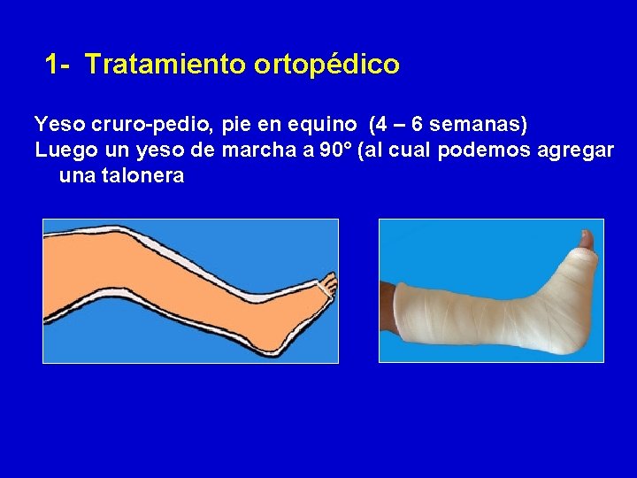 1 - Tratamiento ortopédico Yeso cruro-pedio, pie en equino (4 – 6 semanas) Luego