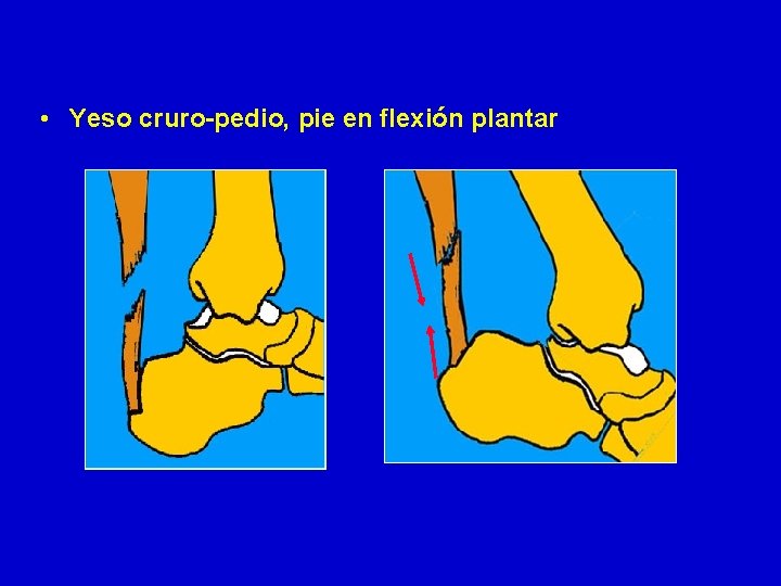  • Yeso cruro-pedio, pie en flexión plantar 