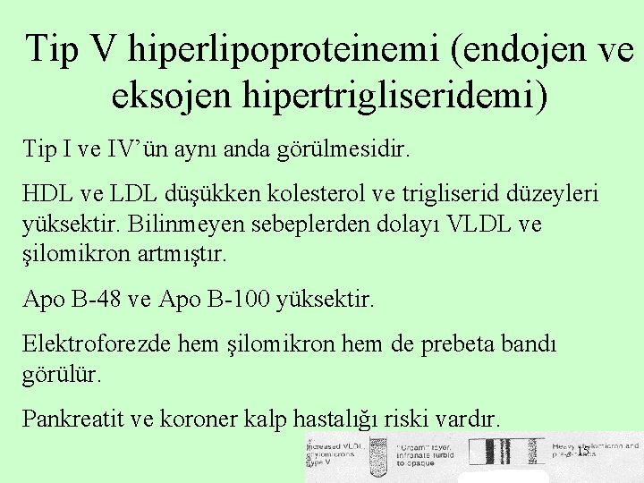 Tip V hiperlipoproteinemi (endojen ve eksojen hipertrigliseridemi) Tip I ve IV’ün aynı anda görülmesidir.