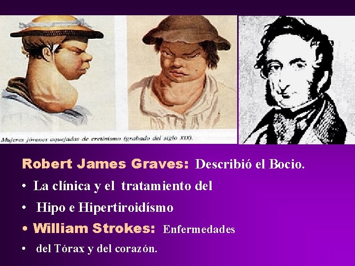 Robert James Graves: Describió el Bocio. • La clínica y el tratamiento del • Robert James Graves: Describió el Bocio. • La clínica y el tratamiento del •