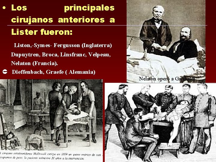 • Los principales cirujanos anteriores a Lister fueron: Liston, -Symes- Fergusson (Inglaterra) Dupuytren, • Los principales cirujanos anteriores a Lister fueron: Liston, -Symes- Fergusson (Inglaterra) Dupuytren,