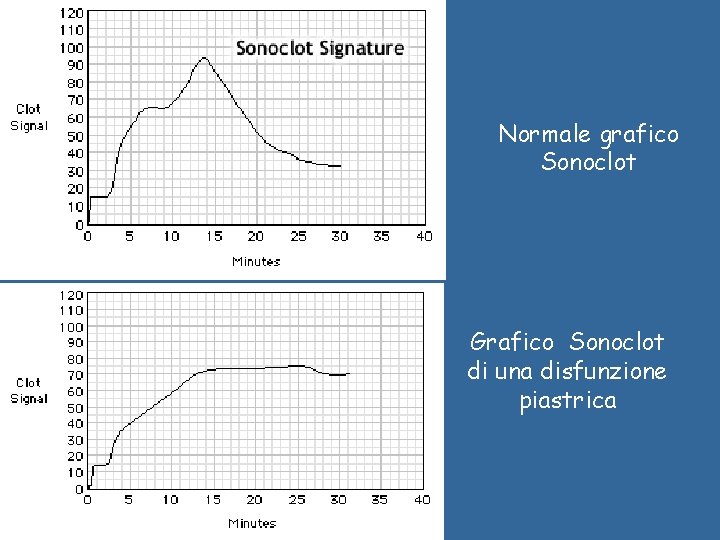 Normale grafico Sonoclot Grafico Sonoclot di una disfunzione piastrica 