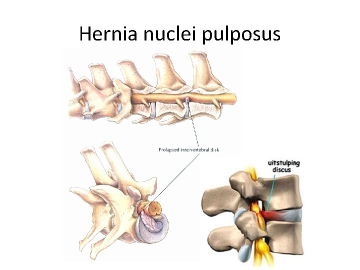 Hernia nuclei pulposus 