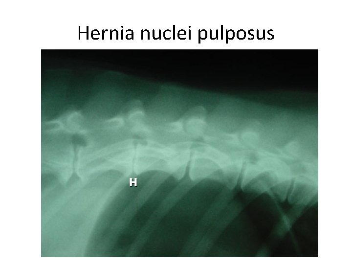 Hernia nuclei pulposus 
