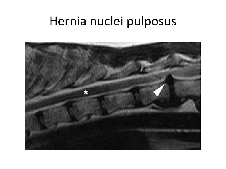 Hernia nuclei pulposus 