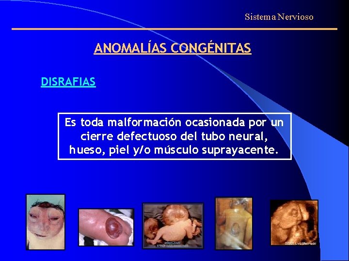 Sistema Nervioso ANOMALÍAS CONGÉNITAS DISRAFIAS Es toda malformación ocasionada por un cierre defectuoso del