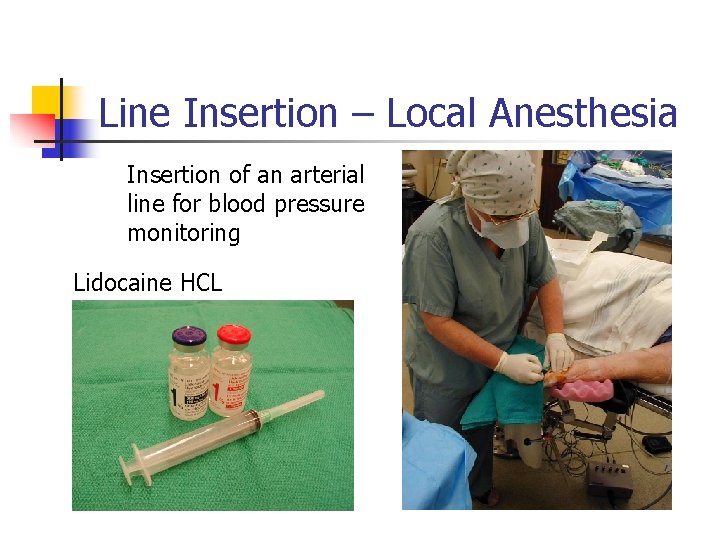 Line Insertion – Local Anesthesia Insertion of an arterial line for blood pressure monitoring