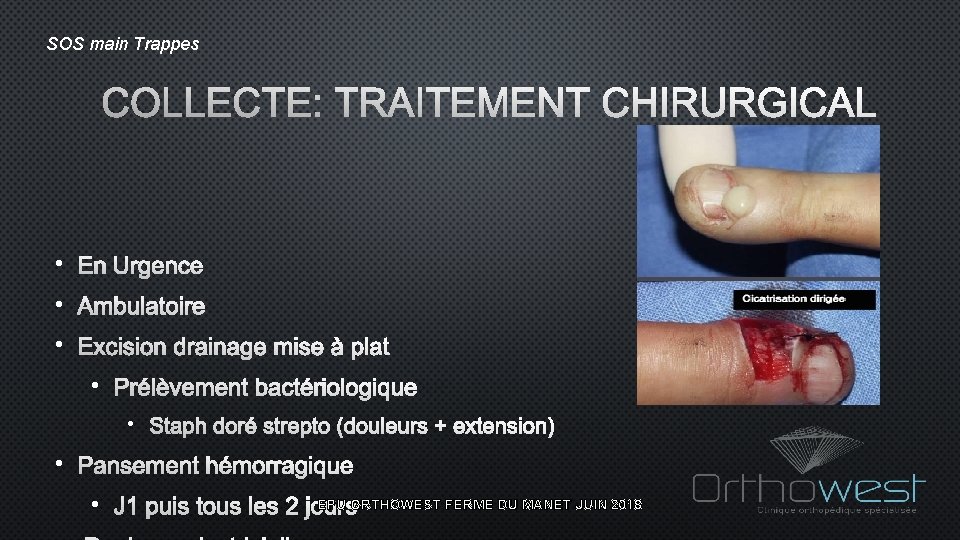 SOS main Trappes COLLECTE: TRAITEMENT CHIRURGICAL • EN URGENCE • AMBULATOIRE • EXCISION DRAINAGE