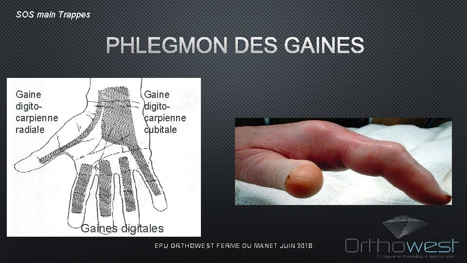 SOS main Trappes PHLEGMON DES GAINES Gaine digitocarpienne radiale Gaine digitocarpienne cubitale Gaines digitales