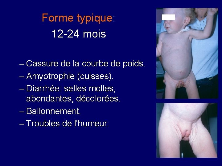 Forme typique: 12 -24 mois – Cassure de la courbe de poids. – Amyotrophie