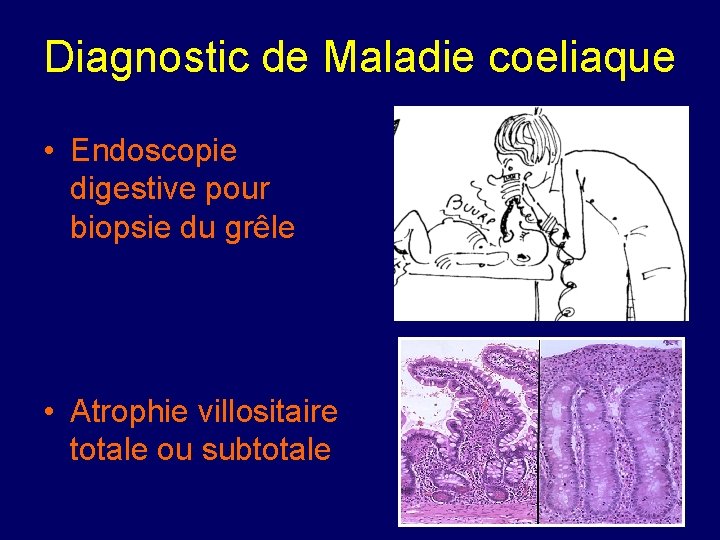 Diagnostic de Maladie coeliaque • Endoscopie digestive pour biopsie du grêle • Atrophie villositaire