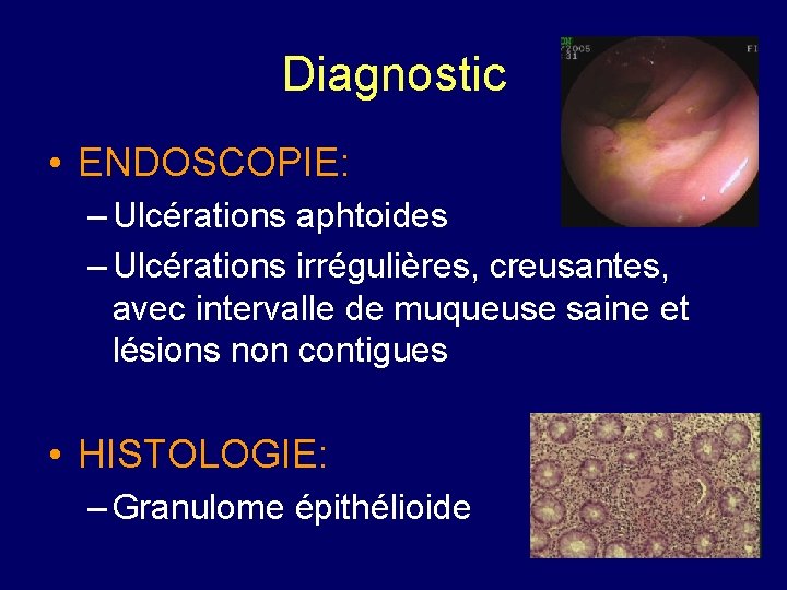 Diagnostic • ENDOSCOPIE: – Ulcérations aphtoides – Ulcérations irrégulières, creusantes, avec intervalle de muqueuse