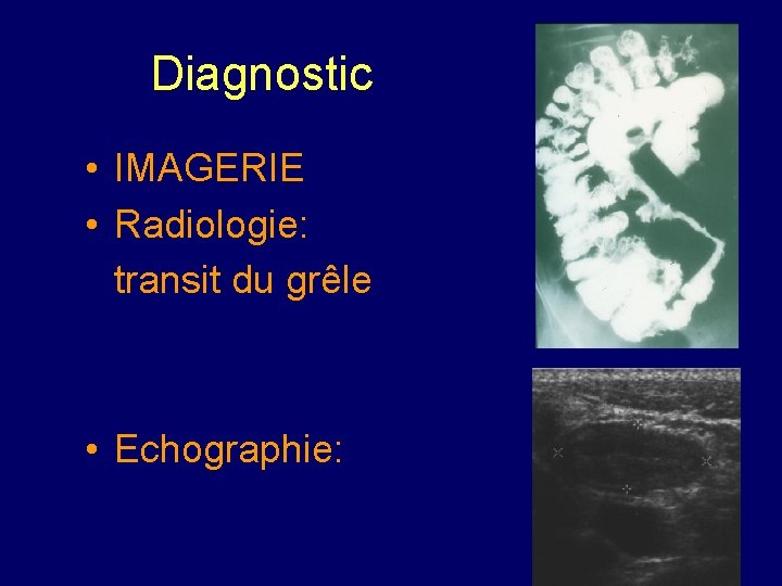 Diagnostic • IMAGERIE • Radiologie: transit du grêle • Echographie: 
