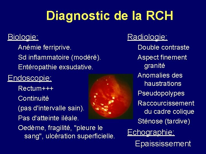 Diagnostic de la RCH Biologie: Anémie ferriprive. Sd inflammatoire (modéré). Entéropathie exsudative. Endoscopie: Rectum+++