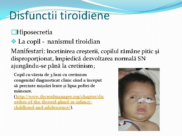 Disfunctii tiroidiene �Hiposecretia v La copil - nanismul tiroidian Manifestari: încetinirea creşterii, copilul rămâne