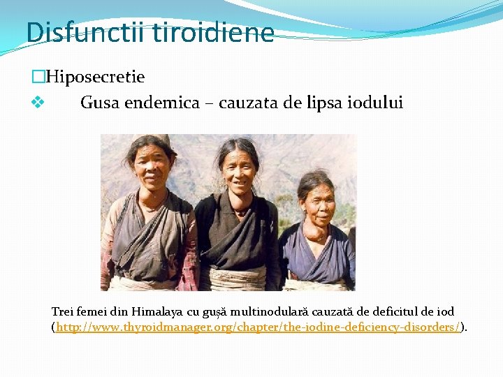 Disfunctii tiroidiene �Hiposecretie v Gusa endemica – cauzata de lipsa iodului Trei femei din