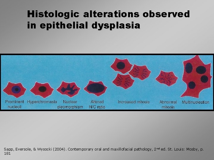 Histologic alterations observed in epithelial dysplasia Sapp, Eversole, & Wysocki (2004). Contemporary oral and