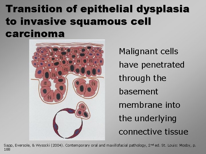 Transition of epithelial dysplasia to invasive squamous cell carcinoma Malignant cells have penetrated through