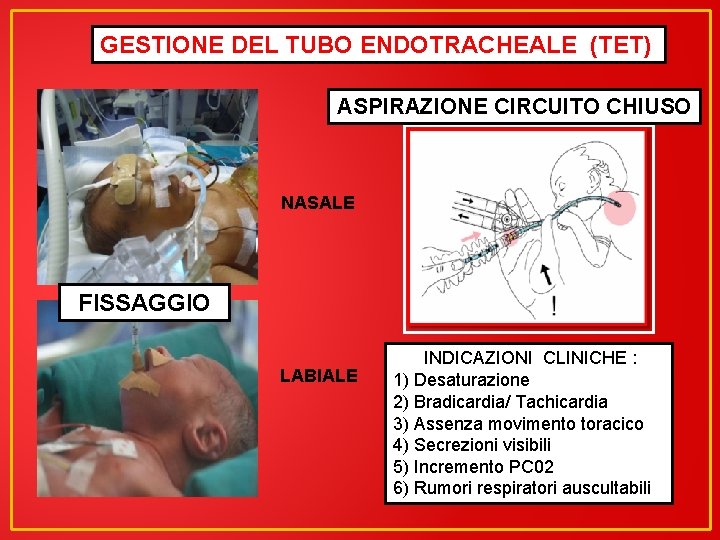 GESTIONE DEL TUBO ENDOTRACHEALE (TET) ASPIRAZIONE CIRCUITO CHIUSO NASALE FISSAGGIO LABIALE INDICAZIONI CLINICHE :