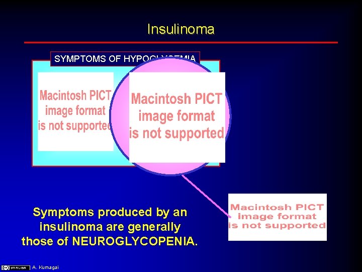 Insulinoma SYMPTOMS OF HYPOGLYCEMIA Symptoms produced by an insulinoma are generally those of NEUROGLYCOPENIA.