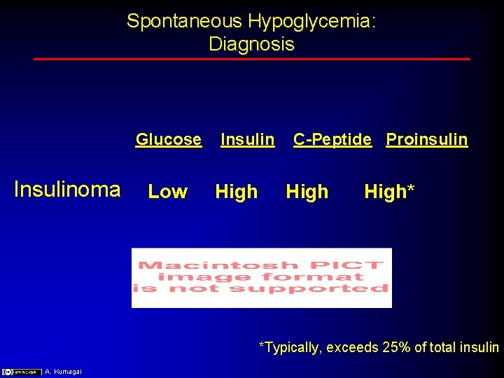 Spontaneous Hypoglycemia: Diagnosis Glucose Insulinoma Low Insulin High C-Peptide Proinsulin High* *Typically, exceeds 25%