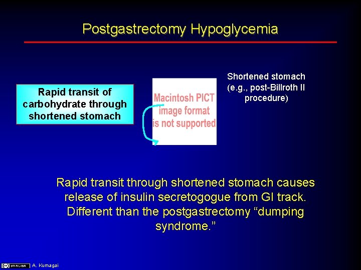 Postgastrectomy Hypoglycemia Rapid transit of carbohydrate through shortened stomach Shortened stomach (e. g. , Postgastrectomy Hypoglycemia Rapid transit of carbohydrate through shortened stomach Shortened stomach (e. g. ,