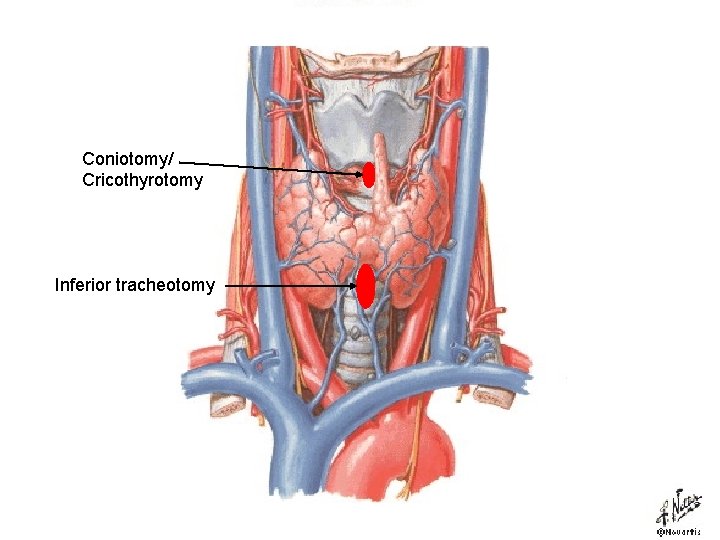 Coniotomy/ Cricothyrotomy coniotomy (cricothyrotomy) Inferior tracheotomy 