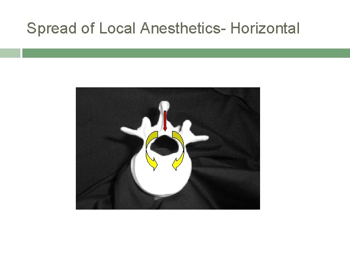 Spread of Local Anesthetics- Horizontal 