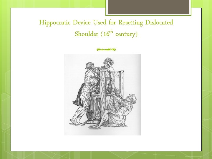 Hippocratic Device Used for Resetting Dislocated Shoulder (16 th century) {{PD-Art-two|PD-US}} 