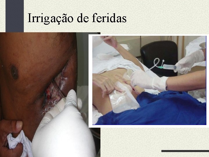 Irrigação de feridas 