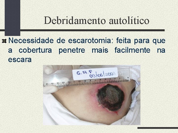 Debridamento autolítico Necessidade de escarotomia: feita para que a cobertura penetre mais facilmente na