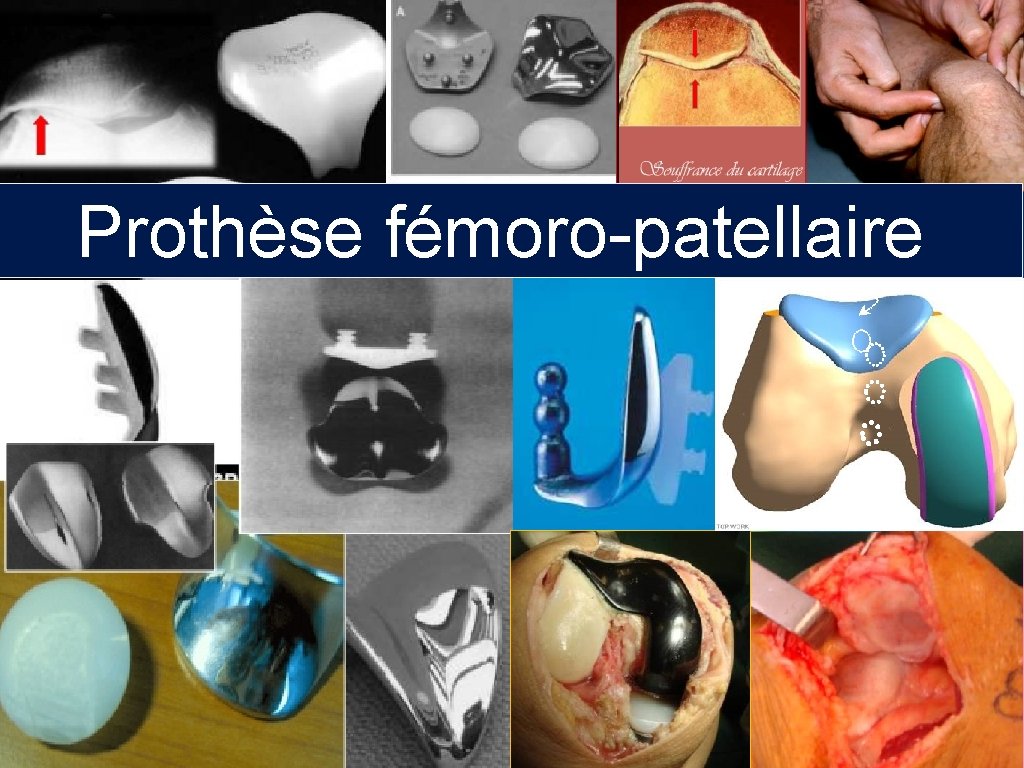 Prothèse fémoro-patellaire 