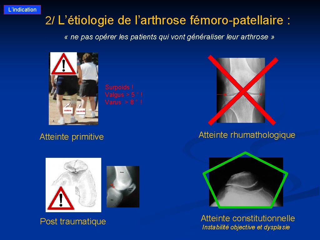 L’indication 2/ L’étiologie de l’arthrose fémoro-patellaire : . « ne pas opérer les patients