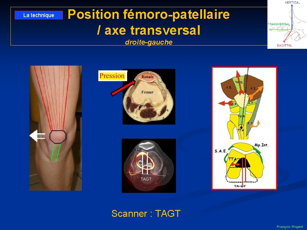 La technique Position fémoro-patellaire / axe transversal droite-gauche TAGT Scanner : TAGT François Prigent