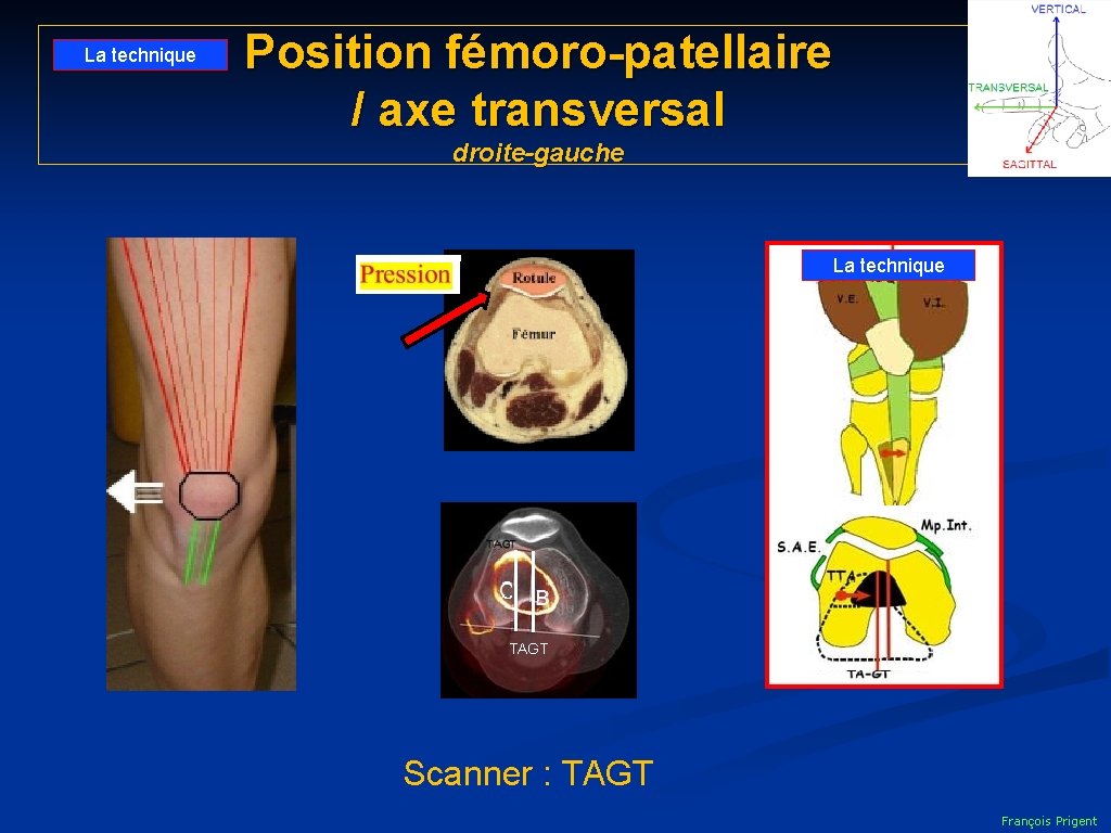 La technique Position fémoro-patellaire / axe transversal droite-gauche La technique TAGT Scanner : TAGT