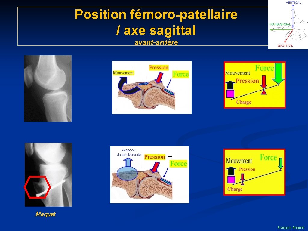 Position fémoro-patellaire / axe sagittal avant-arrière - Maquet François Prigent 