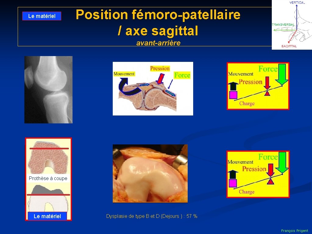 Le matériel Position fémoro-patellaire / axe sagittal avant-arrière + Trochléoplastie Prothèse à coupe Anti