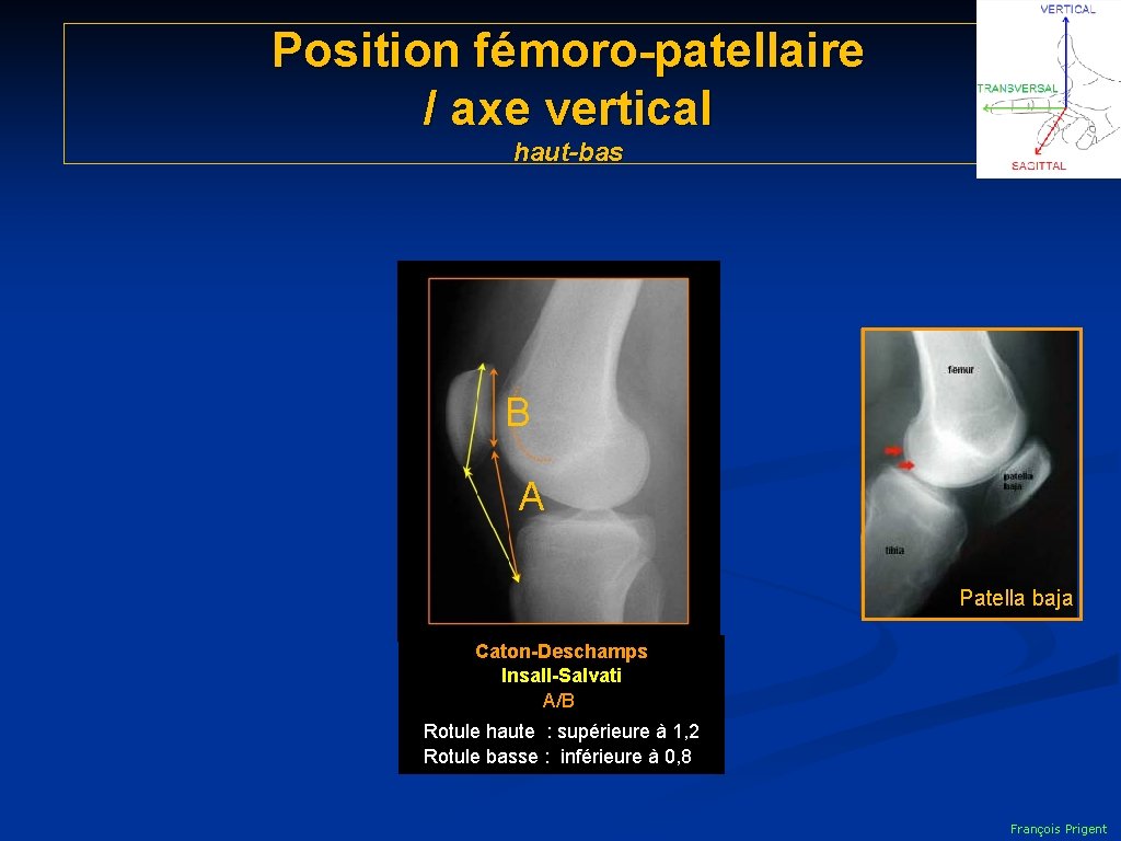 Position fémoro-patellaire / axe vertical haut-bas B A Patella baja Caton-Deschamps Insall-Salvati A/B. Rotule