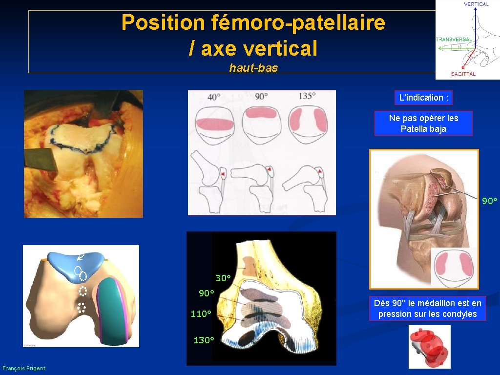 Position fémoro-patellaire / axe vertical haut-bas L’indication : Ne pas opérer les Patella baja