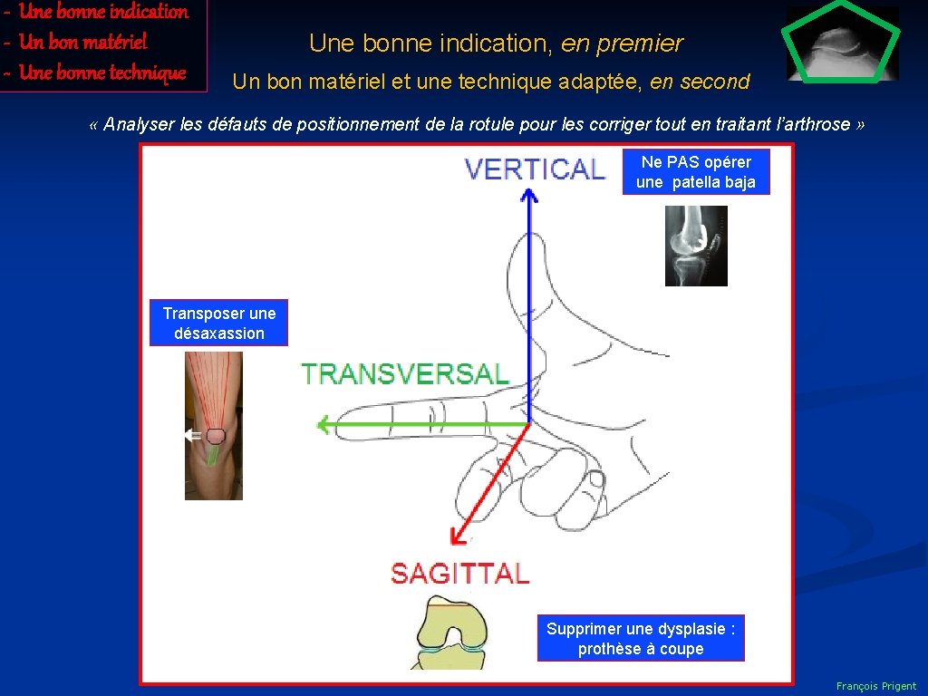 - Une bonne indication - Un bon matériel - Une bonne technique Une bonne